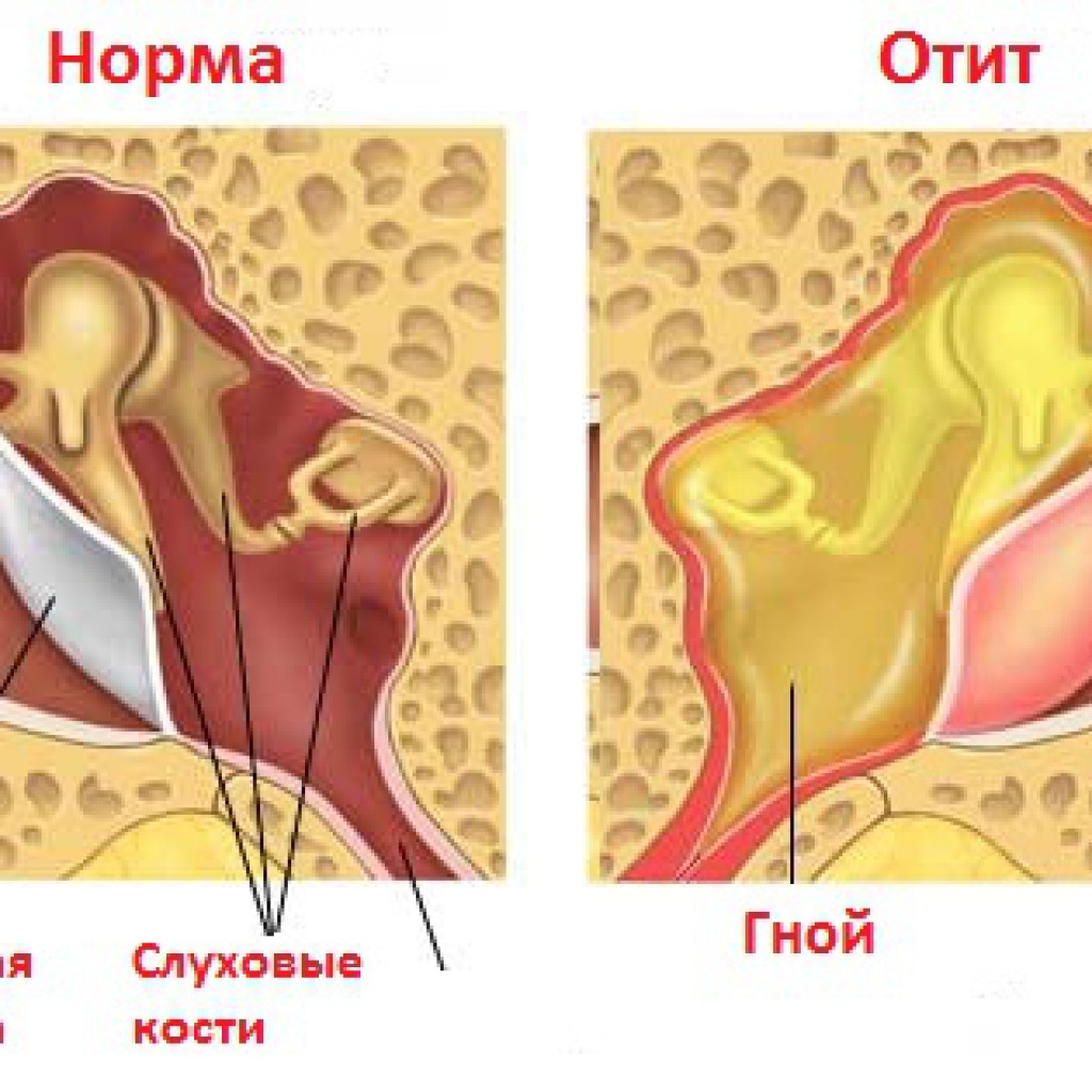 Гнойный отит: причины, симптомы, лечение, фото